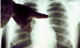 肺癌晚期还能活多久 肺癌末期能活多久